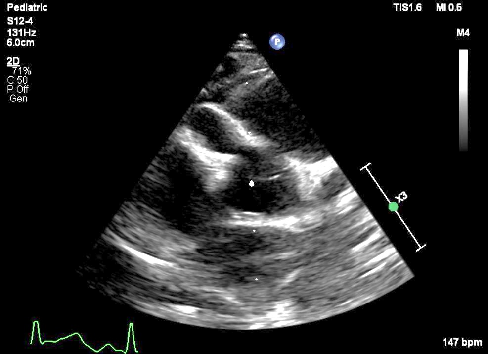 b-Echocardiographie : Anévrysmes coronaires droits et gauches proximaux 