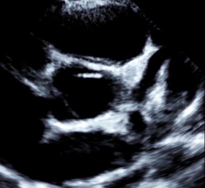 a-Echocardiographie : dilatation du tronc commun coronaire gauche