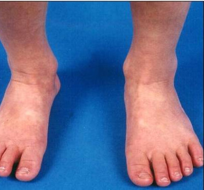 inflammation plante pieds